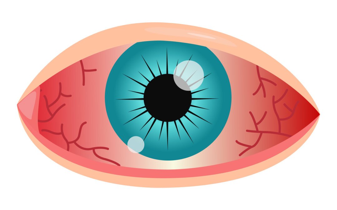Comment reconnaître une urgence ophtalmologique ?