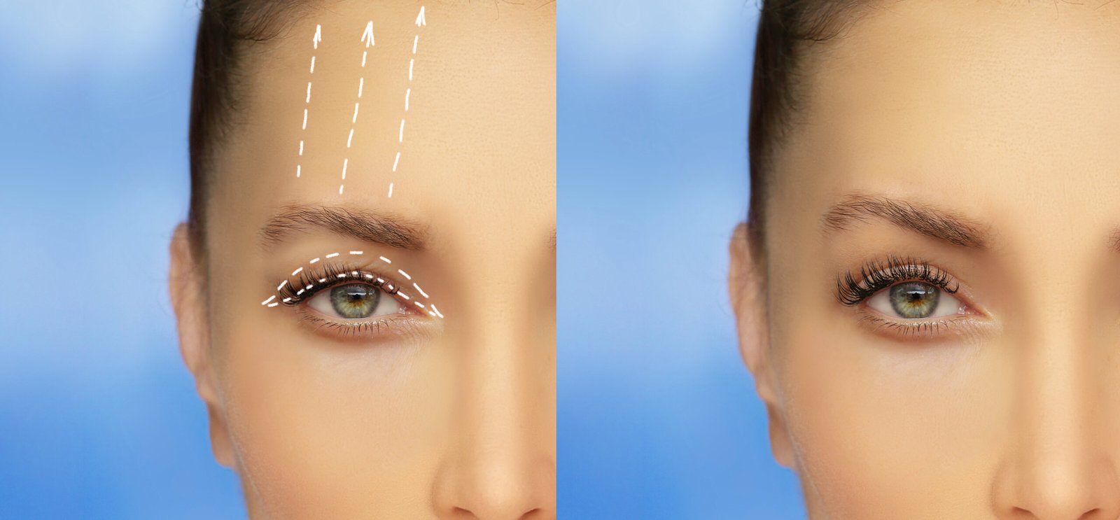 photos avant après une blépharoplastie chez une femme