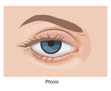 pole-ophtalmologie-colombes-la-defense illustration d'un œil présentant une chute de la paupière appelé un ptosis