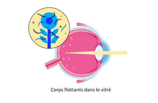 schéma d'un œil montrant les corps flottants lors d'un décollement postérieur du vitré