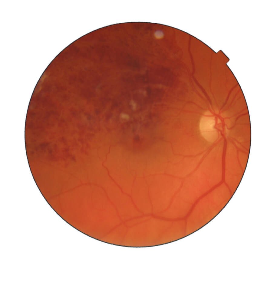 imagerie de la rétine montrant une occlusion veineuse rétinienne