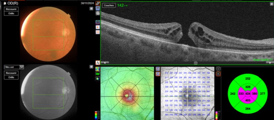 résultats d'examen ophtalmologique dans le cadre du suivi d'un trou maculaire