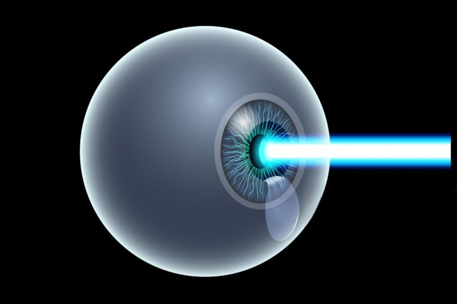 pole-ophtalmologie-colombes-la-defense shéma d'un traitement laser ophtalmologique par LASIK
